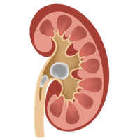 Kidney Stone
